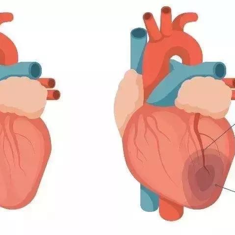 心肌梗死最新診斷標(biāo)準(zhǔn)解讀