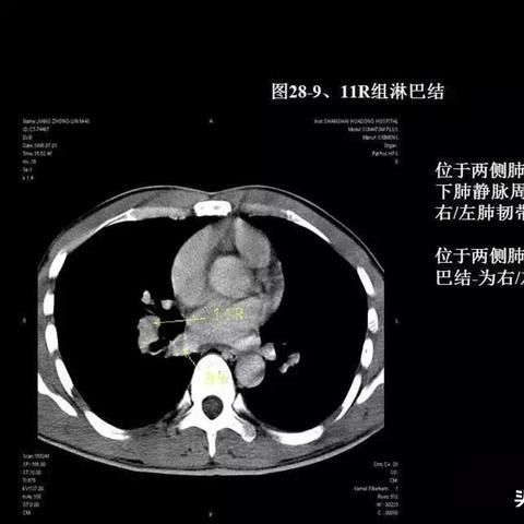 頸部淋巴結分區(qū)最新詳解